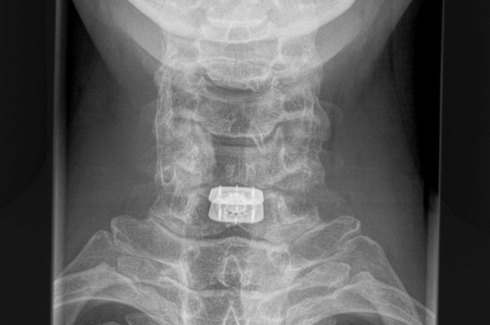 1 level ADR cervical AP